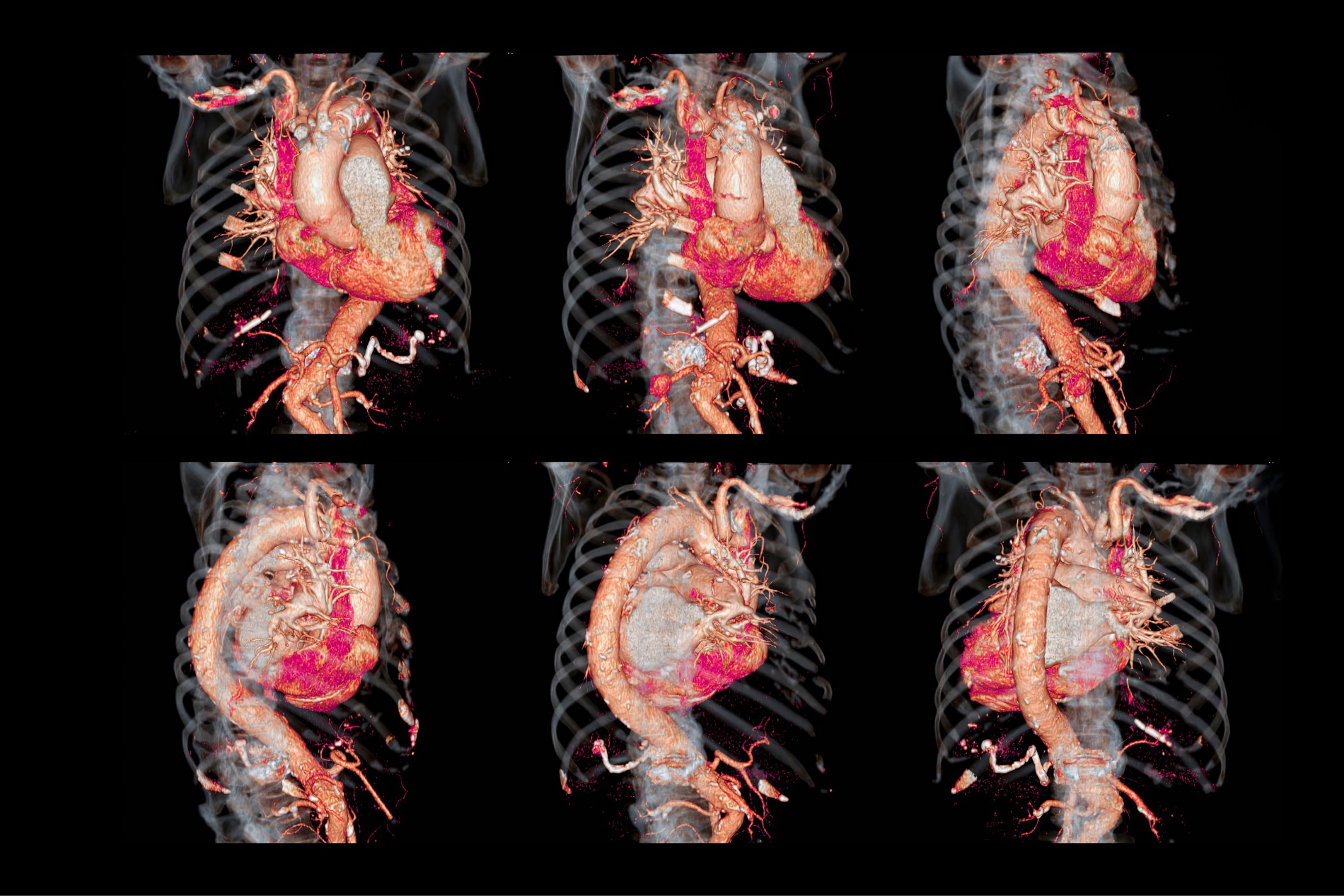 RT- Computed Tomography