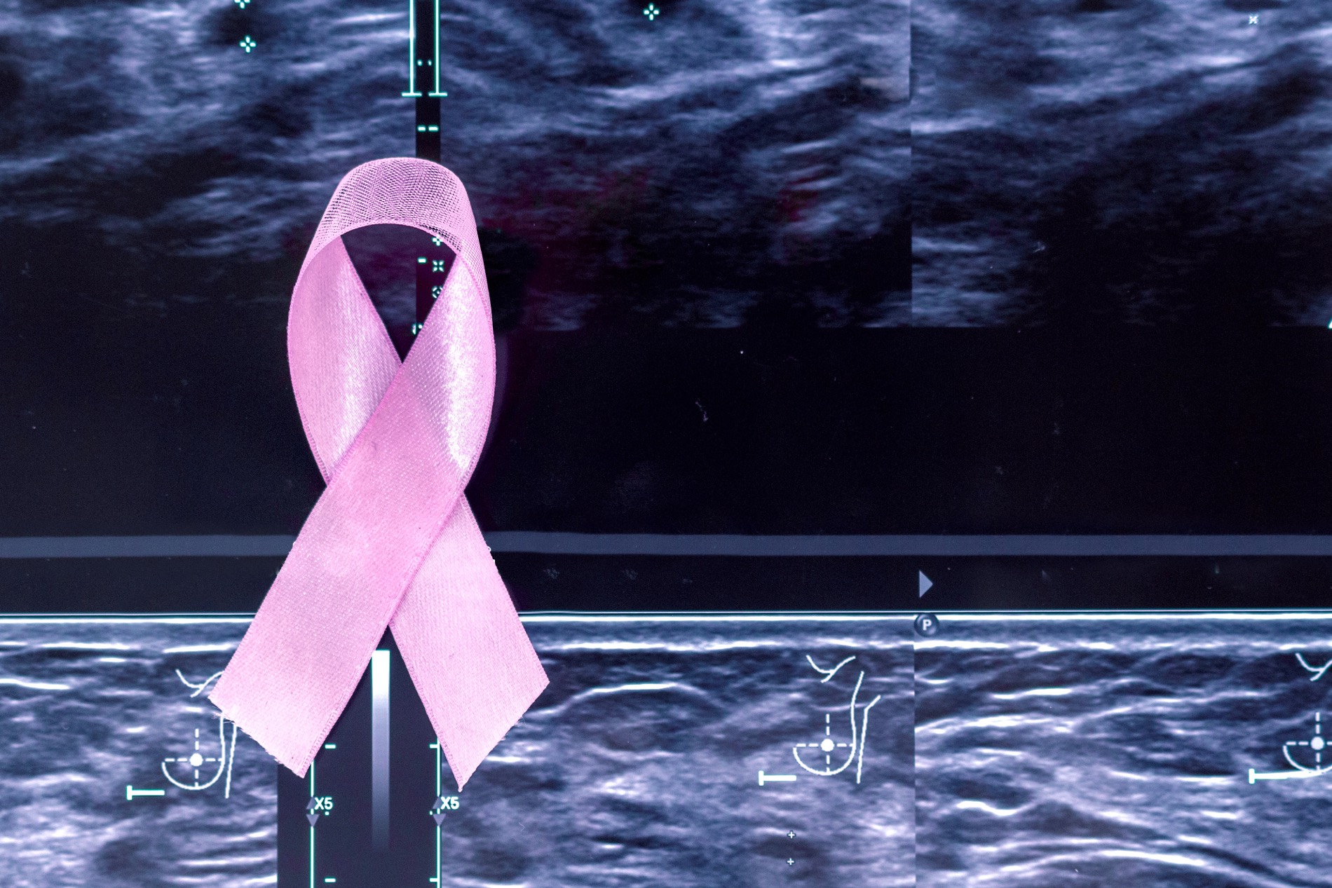 Medical Radiology - Breast Imaging