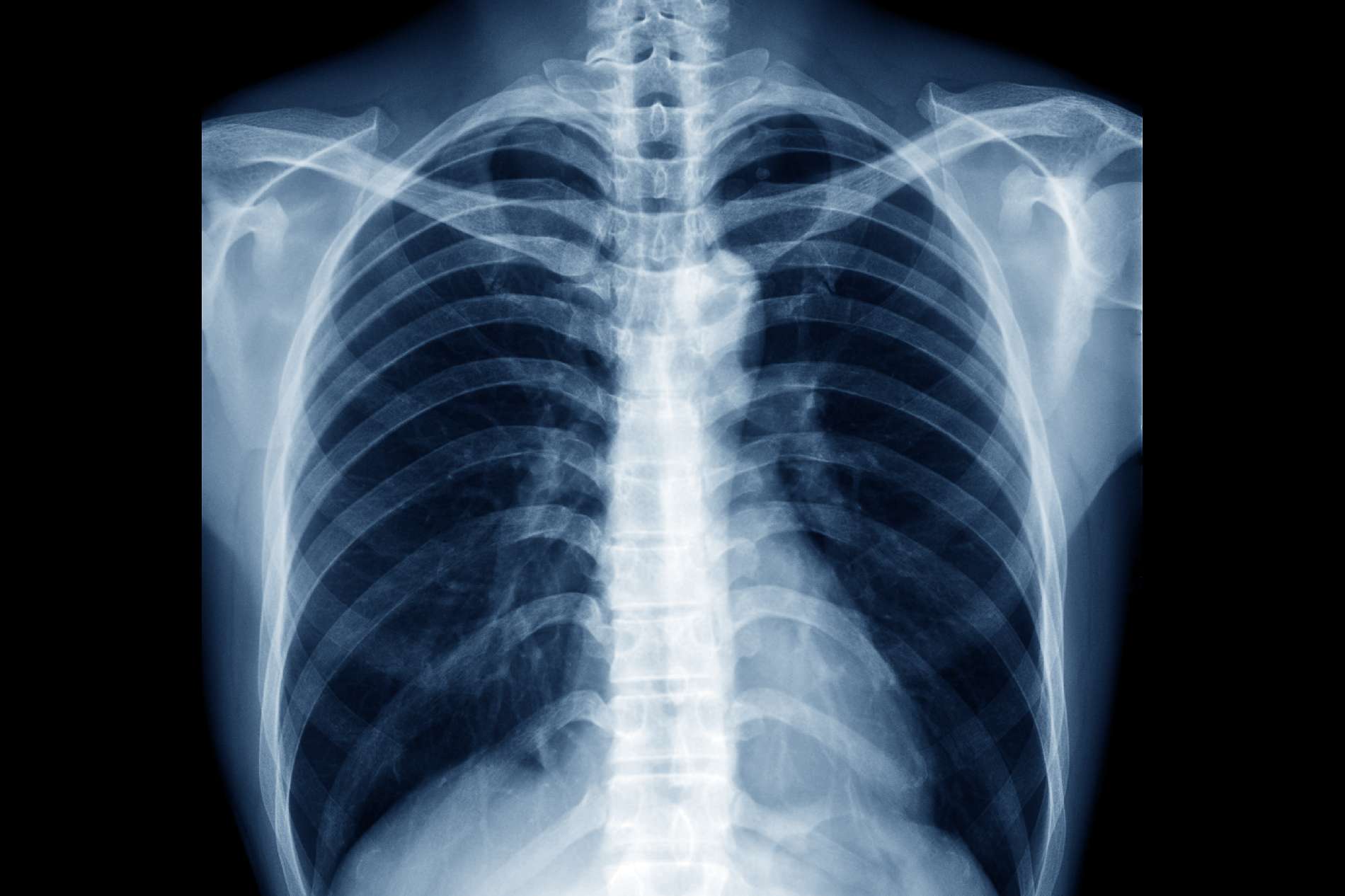 Medical Radiology - Chest 